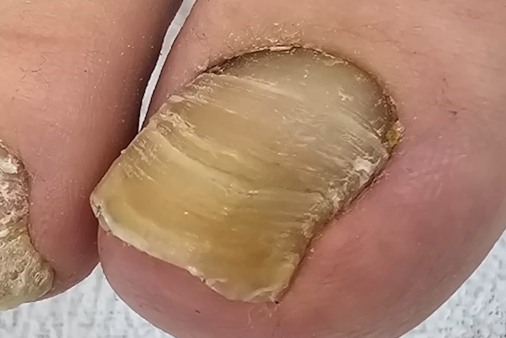 قارچ ناخن شصت پا